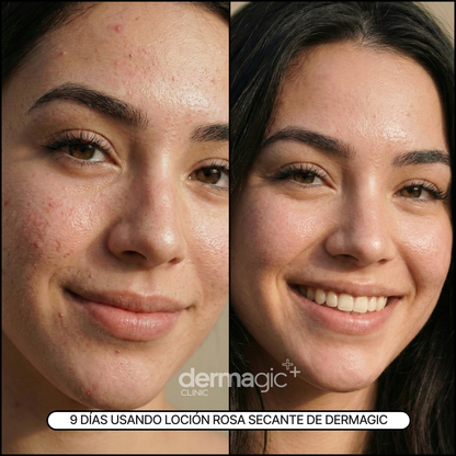 Loción Rosa Anti-Acné Balanz